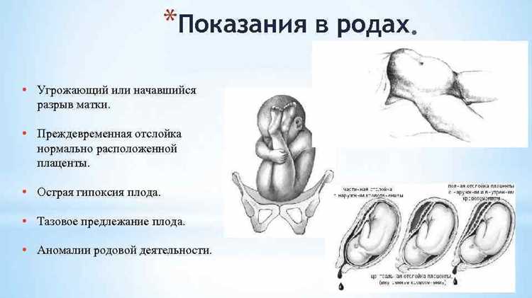 Как неправильное положение влияет на родоразрешение: плановое или экстренное кесарево