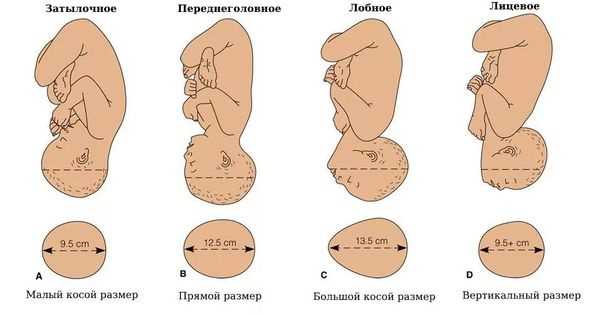 Последствия неправильного положения для матери и ребенка